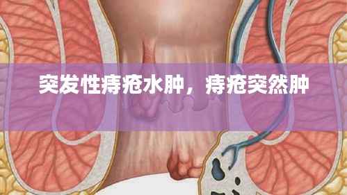 突发性痔疮水肿，痔疮突然肿 